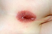 Streptococcal proctitis in a child