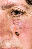 Basal cell skin cancer on the face