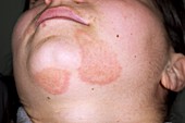 Tinea fungal infection on the face