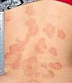 Psoriasis on the back after treatment