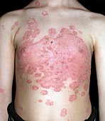 Tinea fungal infection on the body