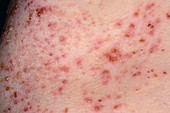 Infected eczema on the skin