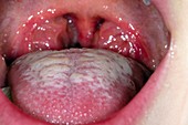 Tonsillitis and furred tongue