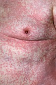 Allergic skin reaction to clopidogrel