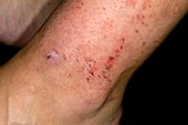 Allergic skin reaction to shin pads