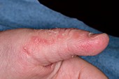 Eczema secondary to thumb sucking