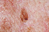 Seborrhoeic wart on the skin