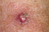 Keratoacanthoma on the skin