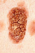 Seborrhoeic wart on the skin