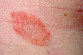 Herald patch in pityriasis rosea