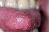 Polyp on the tongue
