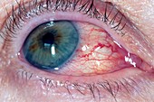 Acute uveitis (iritis) of the eye