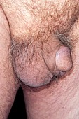 Scrotal bruise after hernia surgery