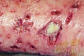 Infected calf injury in a diabetic