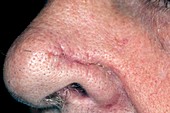 Nose scar after skin cancer removal
