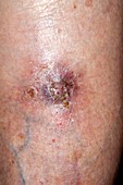 Wound after skin cancer removal