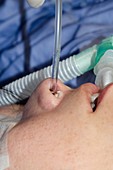 Intubated patient