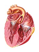 Heart chamber wall defect,artwork