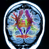 White matter fibres,brain mri scan