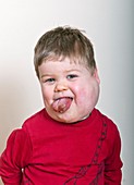 Boy with cystic hygroma