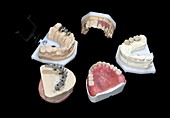 Dental prosthesis production