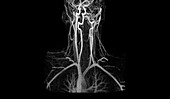 Artery damage,MRA scan