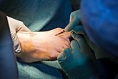 Bunion surgery