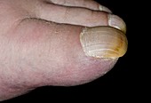 Clubbed toenails
