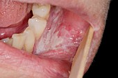 Lichen planus in the mouth