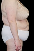 Female obesity after surgery