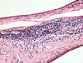 Oesophageal cancer,light micrograph