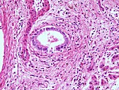 Liver cirrhosis,light micrograph