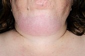 Cellulitis of the neck