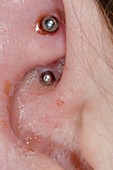 Infected ear piercings