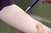 Skin prick allergy test