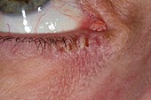 Eczema around the eye