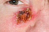 Basal cell skin cancer on cheek