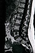 Melanoma spinal cancer,CT scan