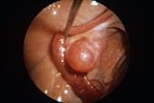 Ovarian follicle,endoscope view