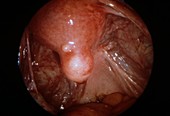 Uterine fibroid,endoscope view