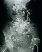 Lymph node tuberculosis,X-ray
