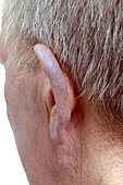 Ear pigmentation from drug side effect