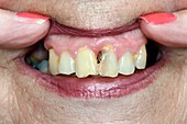 Damaged teeth from chemotherapy