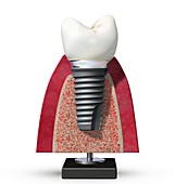 Dental implant,artwork