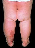 Elephantiasis