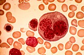 Acute erythroid leukaemia,micrograph