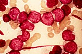 Acute myeloid leukaemia,micrograph