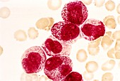 Acute promyelocytic leukaemia,micrograph