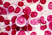 Blood cell cancer,light micrograph