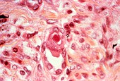 Cytomegalovirus lung infection